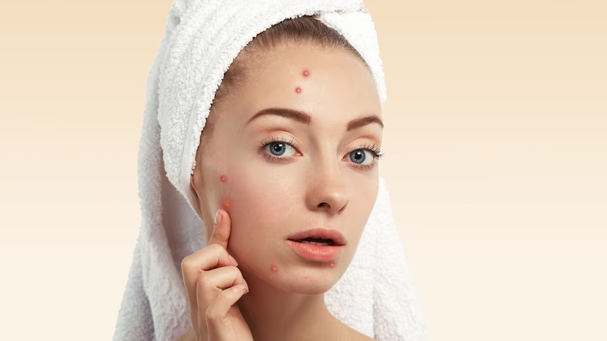 Acne Scars: Try These Natural Methods To Remove It 