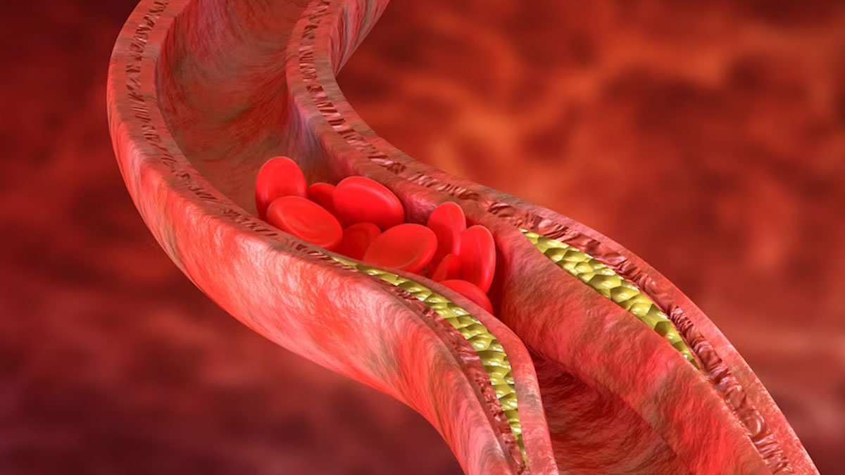 The Primary Causes Of High Cholesterol That Can Be Prevented 